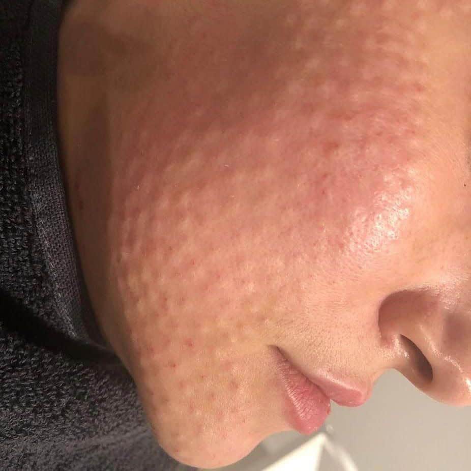 Procedimiento de skin booster en la clínica estética