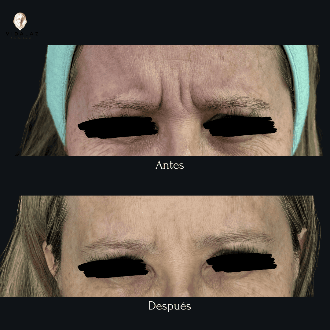 Tratamiento antes y después de Toxina botulínica