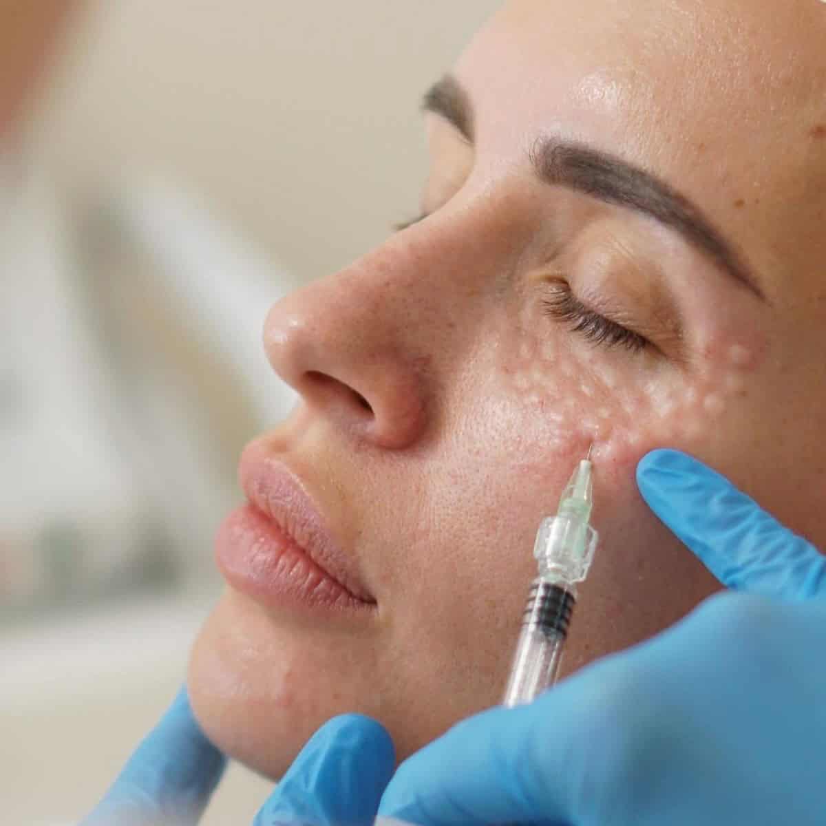 Procedimiento de skin booster en la clínica estética